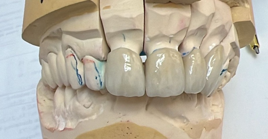 Couronnes sur modèle en plâtre avec contrôle occlusal