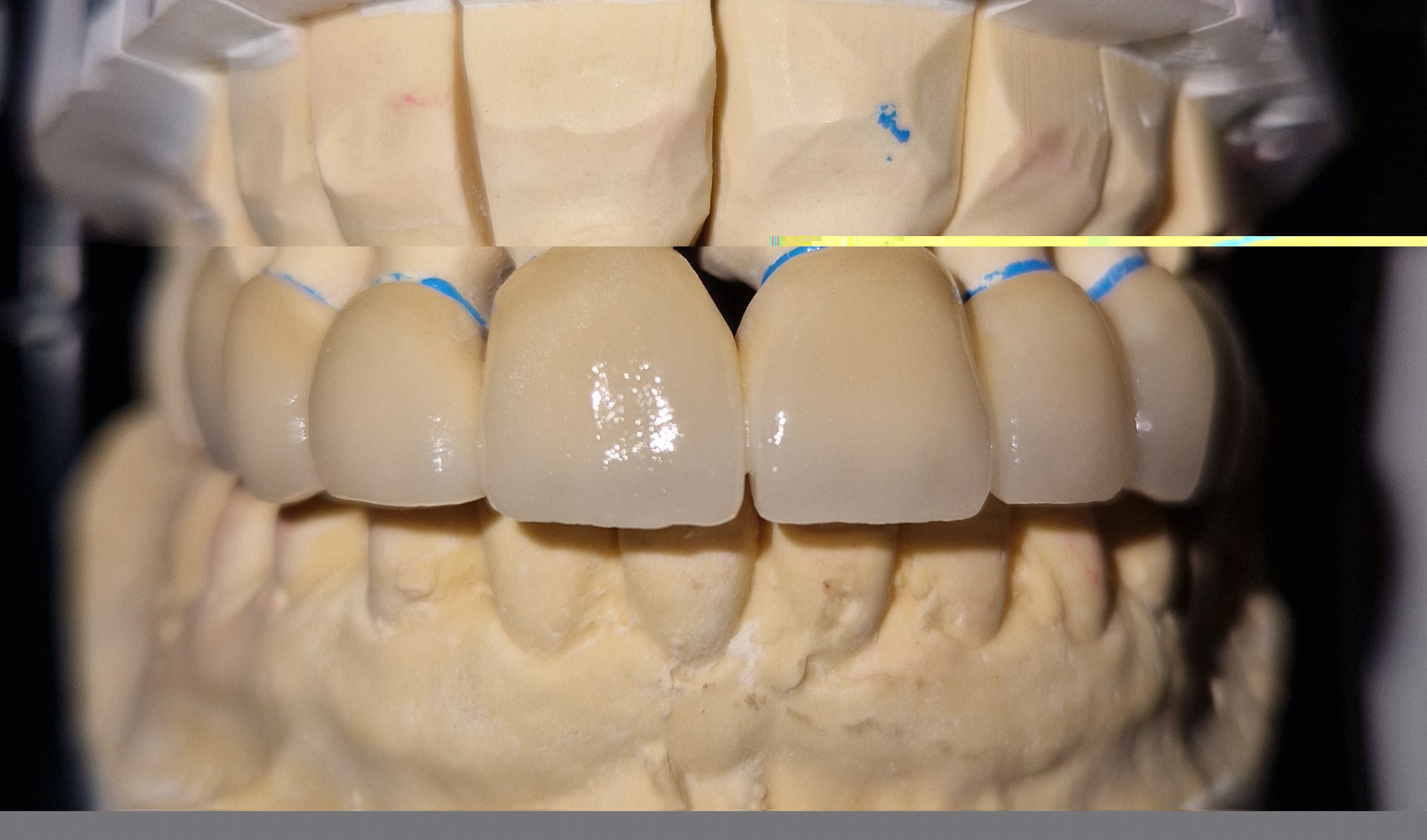 Prothèse fixe sur articulateur — vue de face